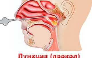Все о пункции верхнечелюстной пазухи