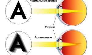 Смешанный астигматизм: что это такое простыми словами