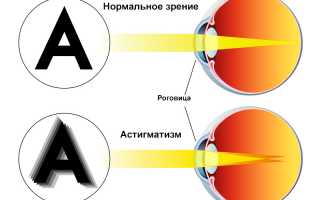 Смешанный астигматизм: что это такое простыми словами