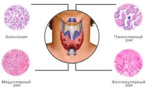 Что такое фолликулярный рак щитовидной железы?