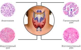 Что такое фолликулярный рак щитовидной железы?