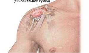 Лечение кисты плечевого сустава