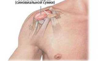 Лечение кисты плечевого сустава