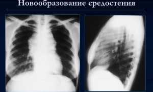 Что такое образование в средостении