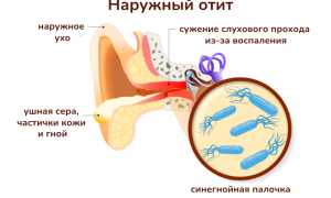 Что вызывает синегнойная палочка и как с ней бороться?