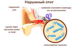 Что вызывает синегнойная палочка и как с ней бороться?