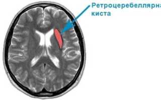 Причины и последствия ретроцеребеллярной кисты головного мозга