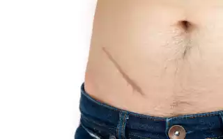 Мытье после аппендицита — когда можно и как правильно