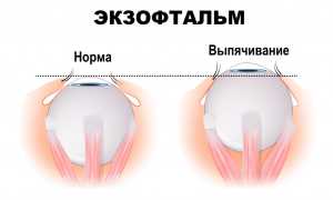 Экзофтальм: что это такое и как с ним бороться?