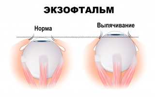 Экзофтальм: что это такое и как с ним бороться?