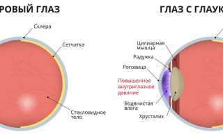 Глаукома: понимание заболевания и его влияние на зрение