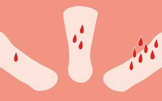 Причины кровянистых выделений между месячными