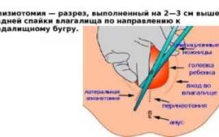 Как заживает шов после эпизиотомии