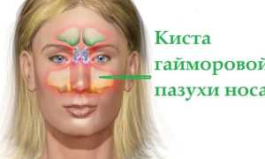 Промывание носа как профилактика кист и лечение ЛОР-заболеваний