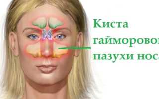 Промывание носа как профилактика кист и лечение ЛОР-заболеваний