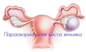 Как вылечить параовариальную кисту яичника