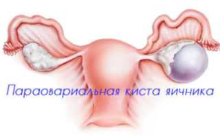 Как вылечить параовариальную кисту яичника