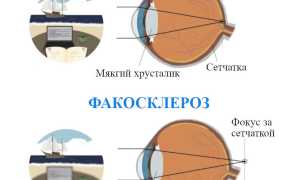 Факосклероз хрусталика глаза: что это такое и как с этим бороться?