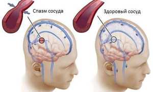 Что такое спазм сосудов головного мозга