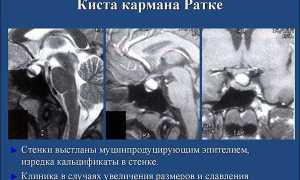 Все о кисте кармана Ратке