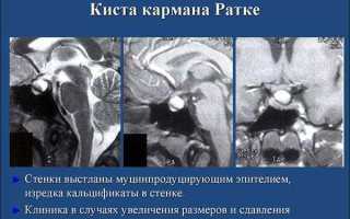 Все о кисте кармана Ратке