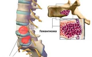 Гемангиома позвоночника: что это такое и как с ней жить?