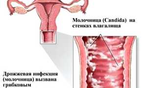 От чего помогает мазь Клотримазол и как ее правильно использовать?