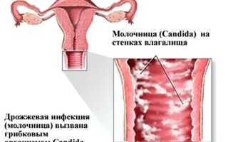 От чего помогает мазь Клотримазол и как ее правильно использовать?