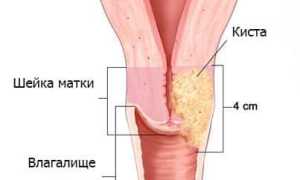 Причины появления и лечение кист шейки матки