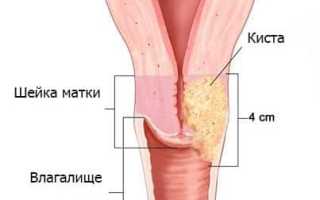 Причины появления и лечение кист шейки матки