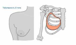 Тубулярная грудь: что это и как с этим справиться?