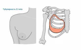 Тубулярная грудь: что это и как с этим справиться?