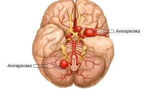 Аневризма головного мозга: симптоматика и методы лечения
