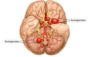 Аневризма головного мозга: симптоматика и методы лечения