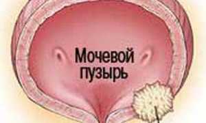 Виды опухолей в мочевом пузыре