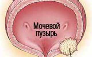 Виды опухолей в мочевом пузыре