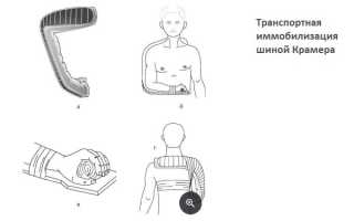 Иммобилизация суставов при переломе плечевой кости