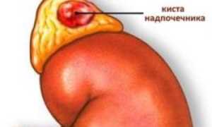 Симптомы и лечение кисты надпочечников