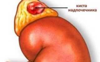 Симптомы и лечение кисты надпочечников