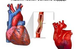 Жалобы при ишемической болезни сердца (ИБС)
