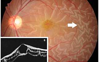 Ретиношизис сетчатки: что это и как с этим жить