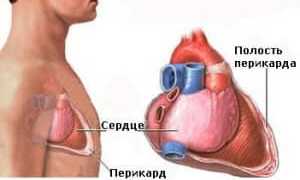 Симптомы и лечение кисты перикарда