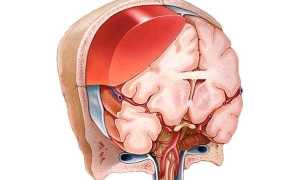 Причины и последствия субдуральной гематомы головного мозга