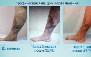 Трофическая язва — опасна ли она для окружающих?