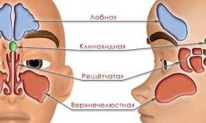 Симптомы и лечение кисты лобной пазухи