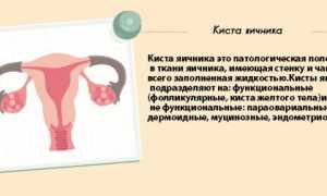 Можно ли заниматься спортом при кисте на яичнике