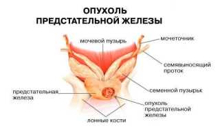 Диагностика и лечение кисты простаты