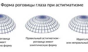 Смешанный астигматизм обоих глаз: что это и как с ним жить