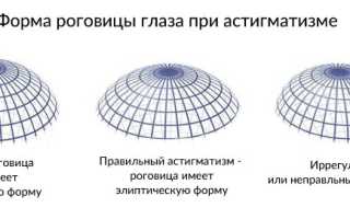 Смешанный астигматизм обоих глаз: что это и как с ним жить