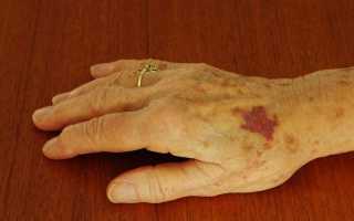 Почему появляются синяки по телу без причины у пожилых